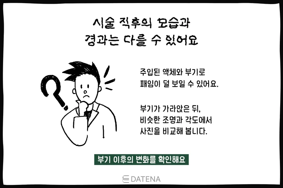 施術直後は腫れや液体の注入でくぼみが目立ちにくく見えることを説明する人物イラスト