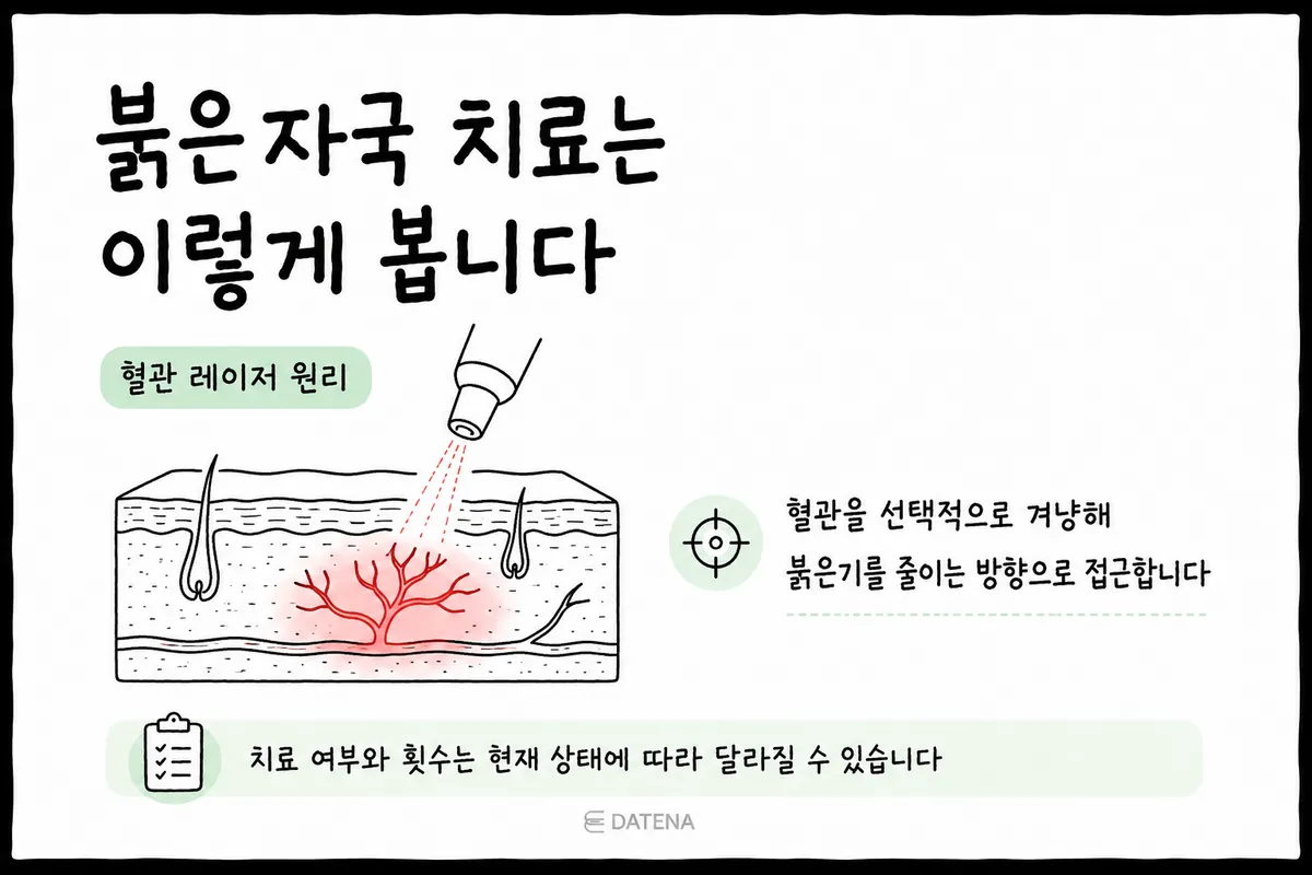 ニキビの赤み跡の拡張した血管をターゲットにする血管レーザーの原理図