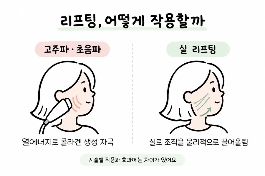 高周波・超音波リフトと糸リフトの作用の仕組みを顔のイラストで比較